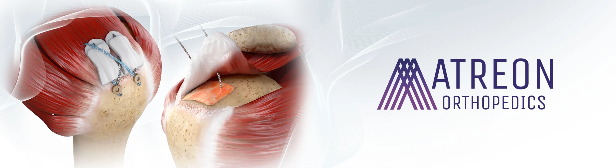 149.125" x 92.125" backlit display of the Rotium® Bioresorbable Wick and BioCharge® Autobiologic Matrix at AAOS 2025